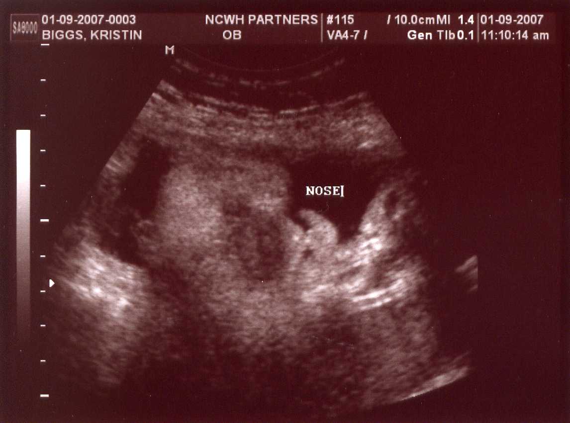 [Jack's+nose+and+lips+at+35+Weeks.jpg]