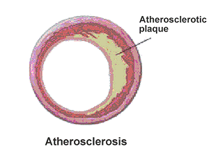 [atherosclerosis.gif]