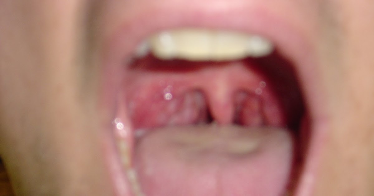 deepthroat Tonsils removed