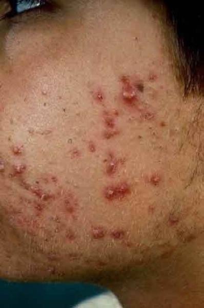 [acne_vulgaris.jpg]