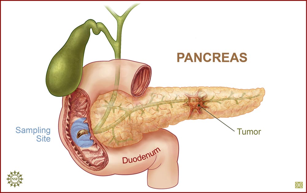 [pancric-cancer-illustration.jpg]