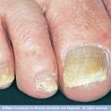 [Nail+fungal+infection.jpg]