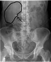 [kidney+stones.jpg]