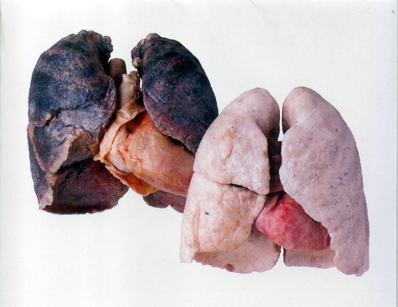 [BW+lungs.jpg]