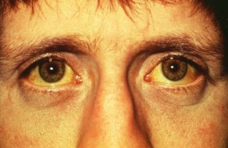 Eyes that are Yellow