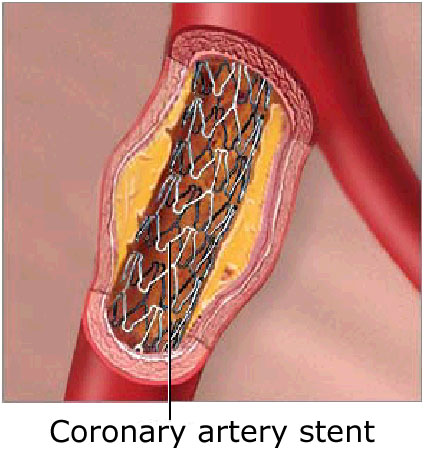 [stent2.jpg]