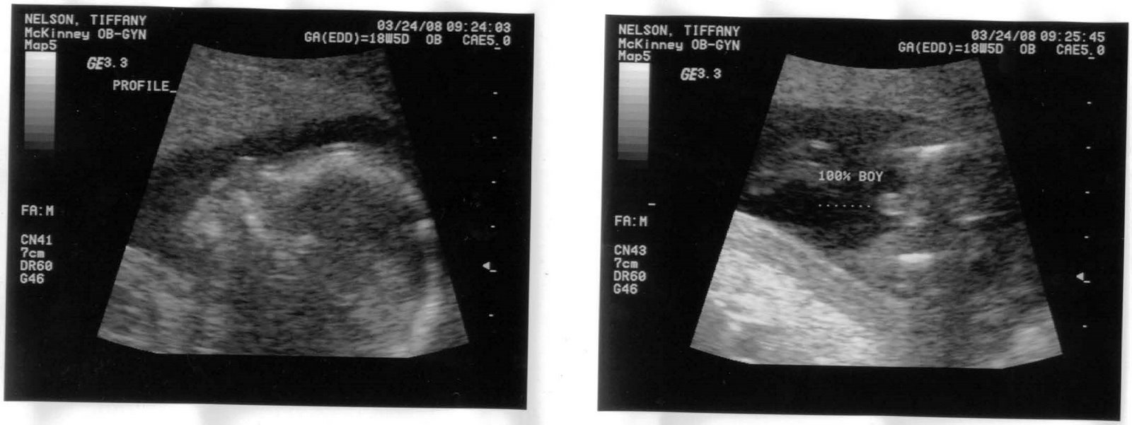[18+week+5+day+ultrasound.jpg]