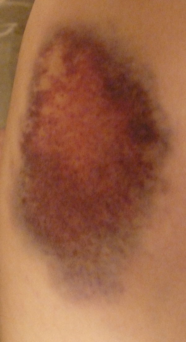 [Bruise.jpg]