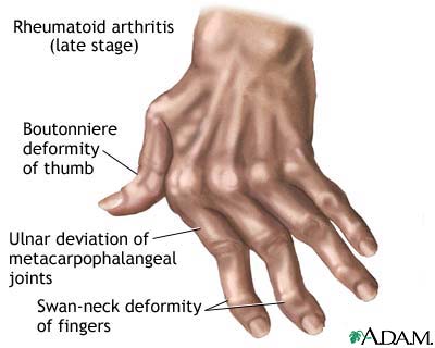 [Rheumatoid+Arthritis.jpg]