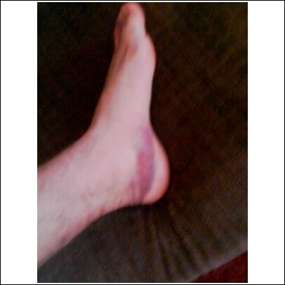 [ankle+sprain+2.jpg]