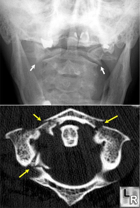 Example of a 3 place Jefferson Fracture