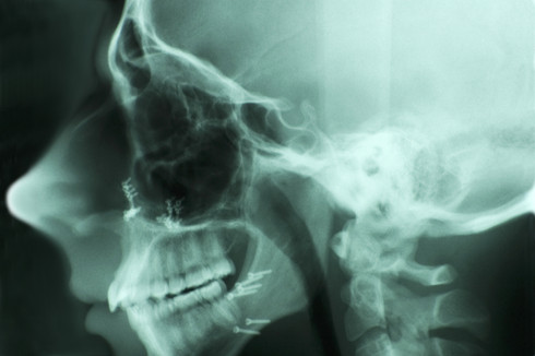 [LuckyOliver-2783049-blog-head_x-ray_with_screws.jpg]