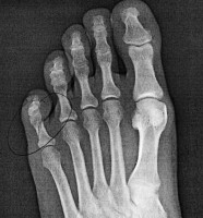 [_2005-09-30--matts-broken-toe.jpg]