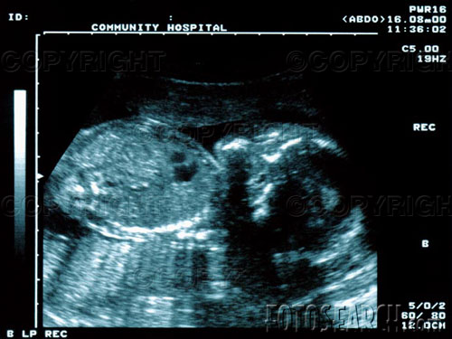 [Baby_Ultrasound_1.jpg]