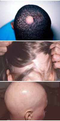 [alopecia_areata.jpg]
