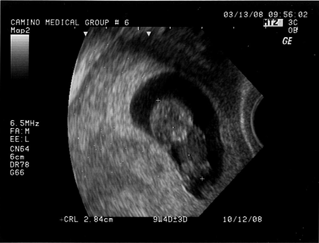 [Ultrasound-03-13-2008+(2).JPG]
