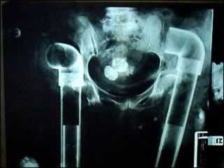 lightbulb x-ray