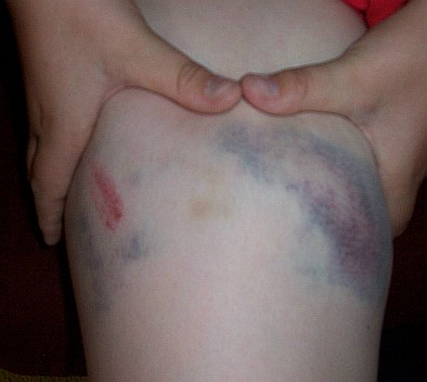 [bruise2.jpg]