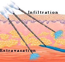 IV site infiltration and extravassation