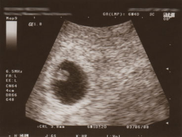 [Baby3-First-Ultrasound.jpg]