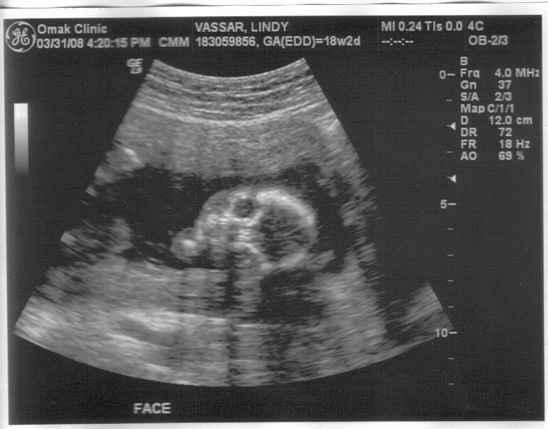 [3-08+ultrasound+V.jpg]