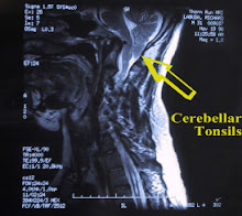 mri of tonsils entering spinal canal