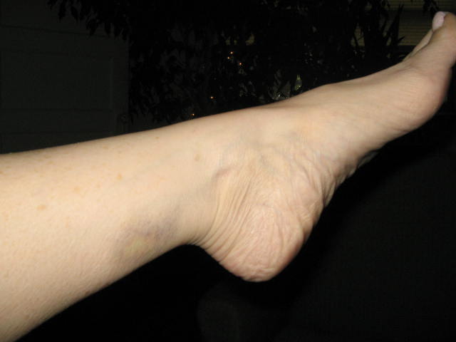 [feetRAcheck02_bruise.JPG]