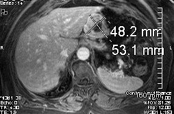 [gastric+tumor.jpg]
