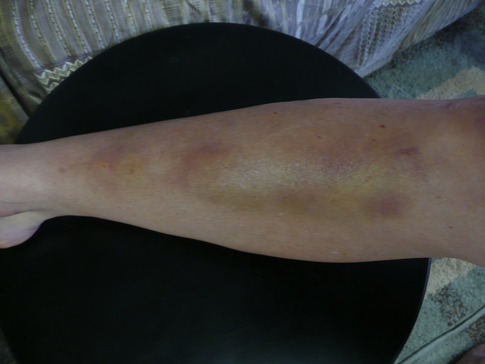 [Bruise+Shin.JPG]