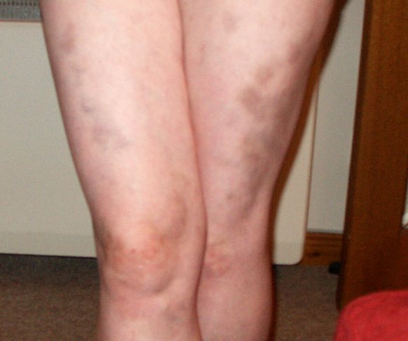 [bruised+legs.jpg]