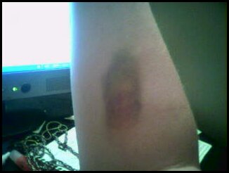 [Mista's+IV+Bruise+July+30+2008.jpg]