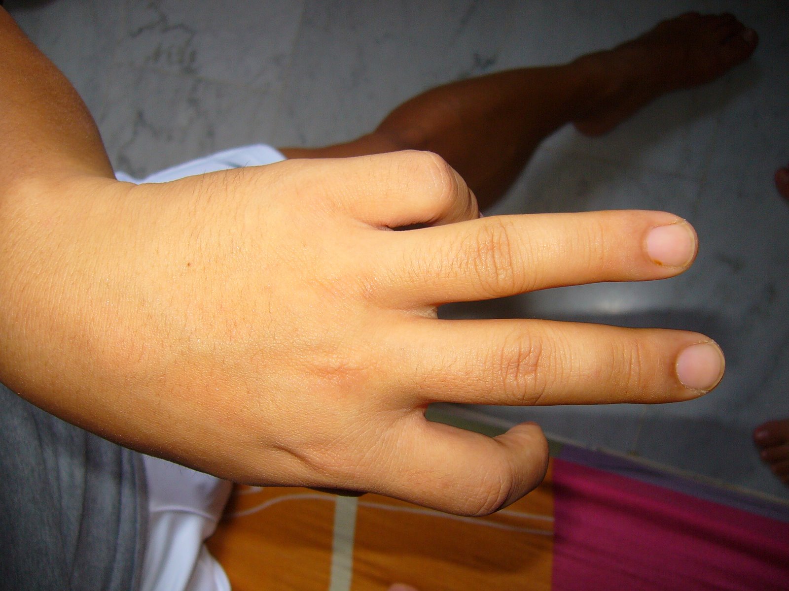[3-4th+finger+injury.JPG]