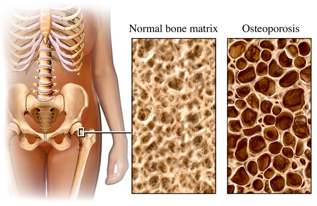 [osteoporosis.jpg]