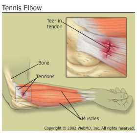 [Tennis+Elbow.jpg]