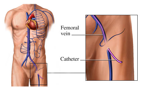 [Catheter+placement+in+the+femoral+vein1.jpg]