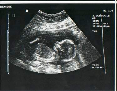 [pregnancy-ultrasound-17-weeks.jpg]