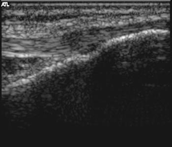 [tendon+ultrasound.jpg]