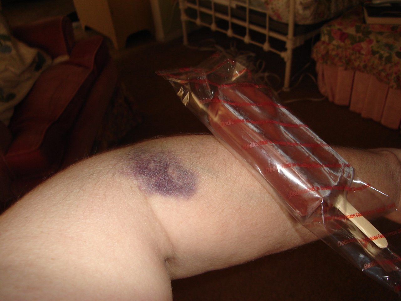 [June+9+bruise+001.jpg]