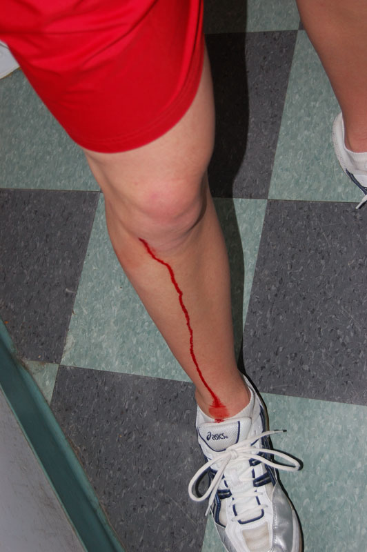 [bleeding_leg.jpg]