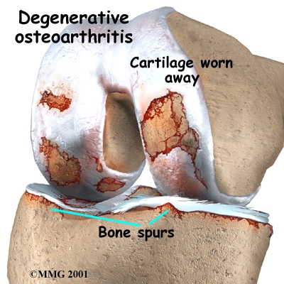 [knee_osteoarth_anatomy02.jpg]