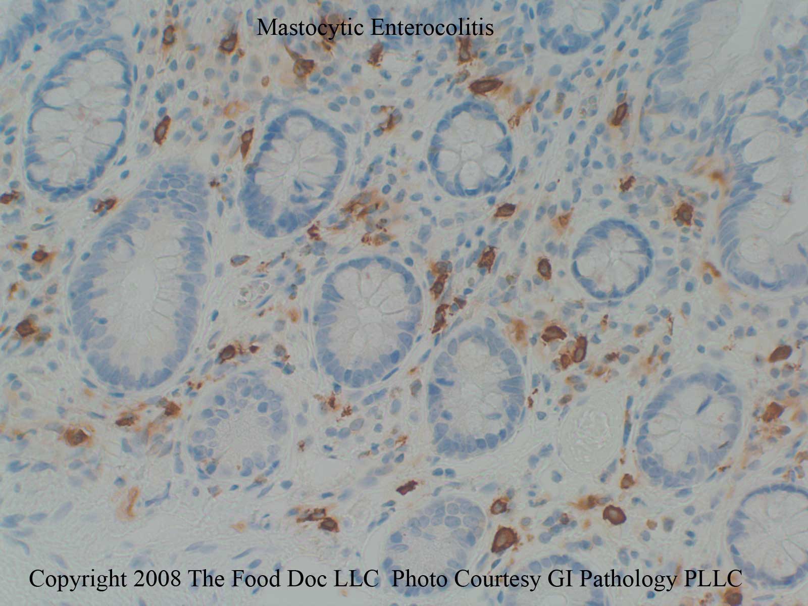 [mastocytic-enterocolitis-histology-for-web.jpg]