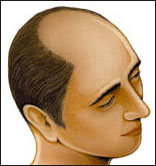 [alopecia_androgenetica_uomo.jpg]