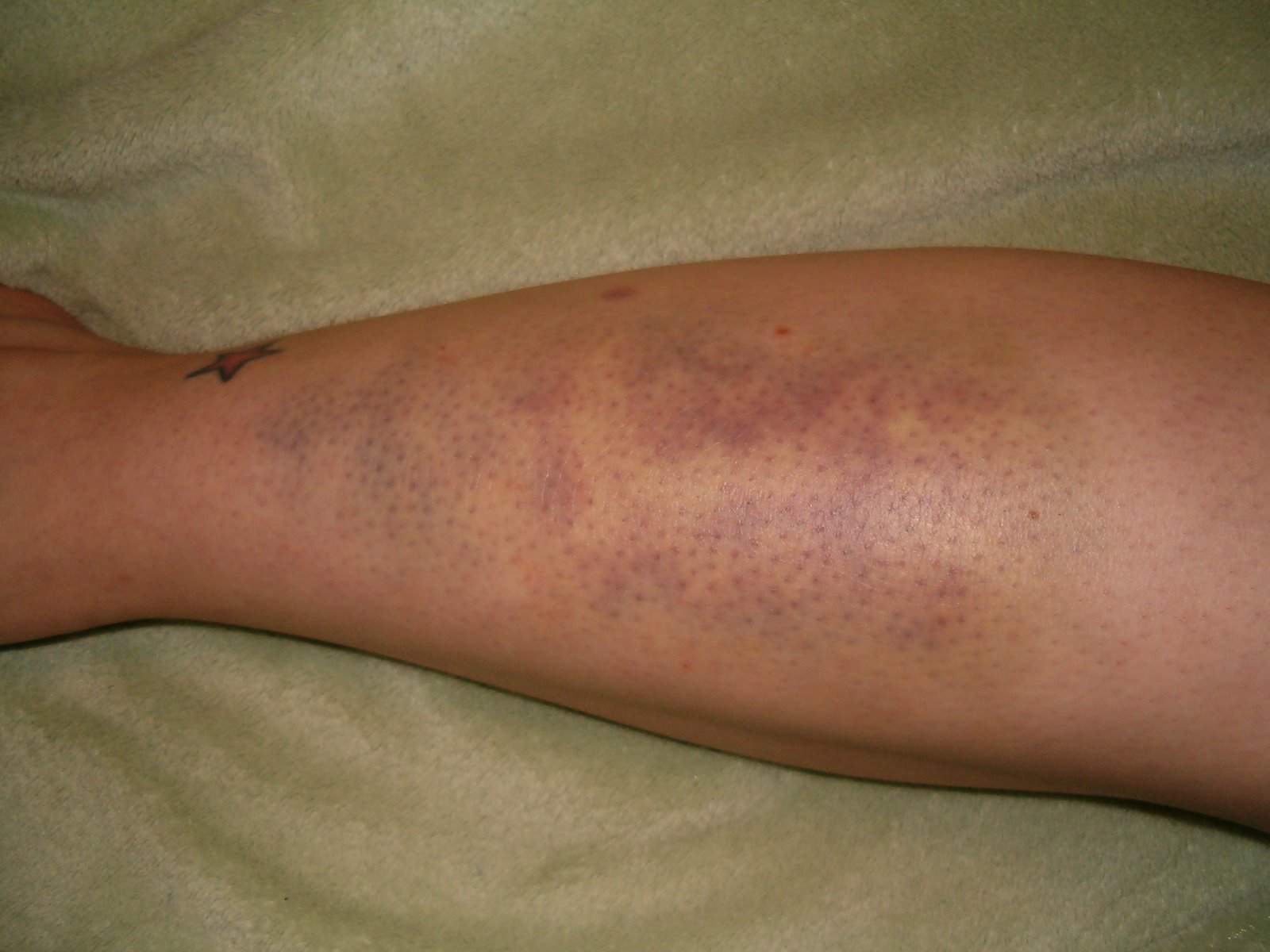 [bruise+001.jpg]