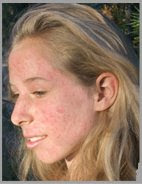Before Learning the Proven Method on How to Stop Acne