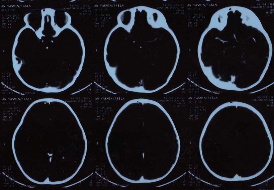 [CT+Scan+of+a+brain+of+14+month+old+child++with+athetoid+CP--ALPHA+AMIRRACHMAN.jpg]