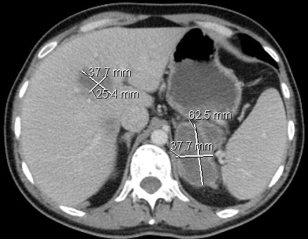 CT Scan Liver post chemo4 for comparison