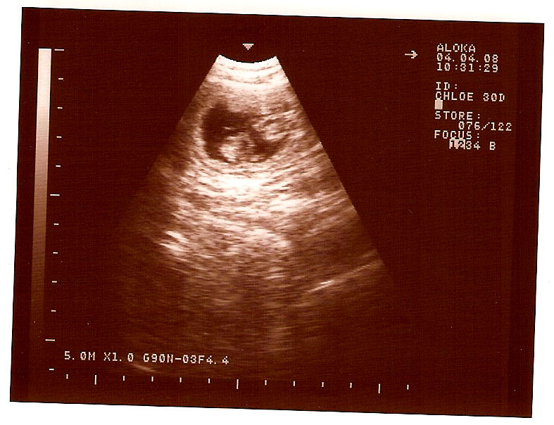[Kloe's+ultrasound0001a.jpg]