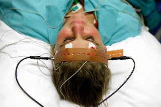 ECT electroconvulsive therapy electroshock Depression Unipolar Treatment-resistant-depression