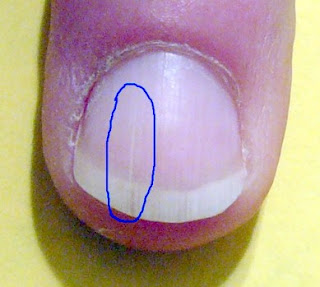 Cause & cure for fingernail split down the middle - The ...