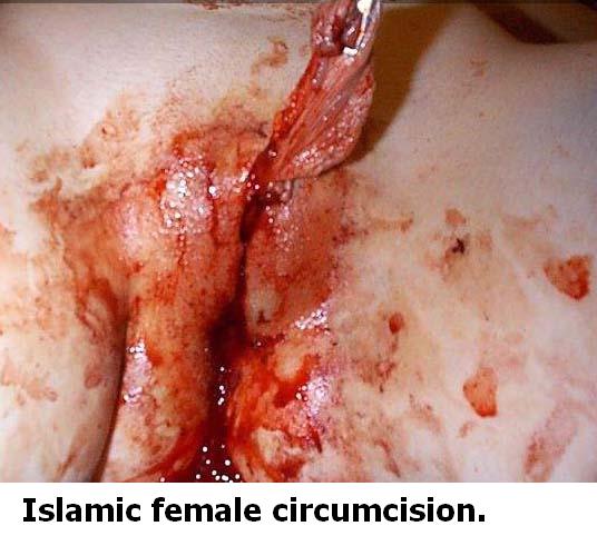 [islamic+female+ciscumcision.JPG]